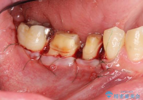 深い虫歯 セラミッククラウンの精度を高める歯周外科手術の治療中