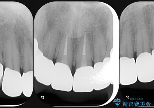 [ 審美歯科  オールセラミッククラウン ]  前歯をとにかく白くしたいの治療後