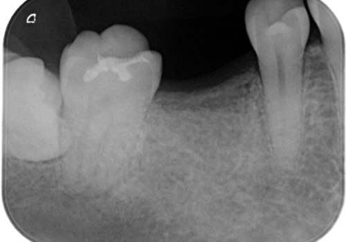 失ったままの臼歯　インプラントによる治療の治療前