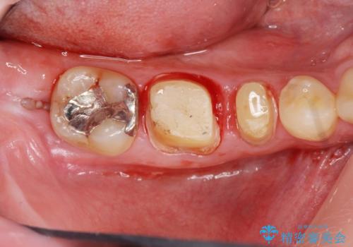 深い虫歯　セラミッククラウンの精度を高める歯周外科手術の治療中