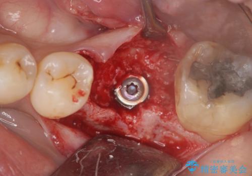 失った奥歯をインプラントで機能回復の治療中