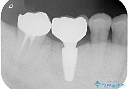 【インプラント】奥歯でしっかり物を噛みたい。の治療後