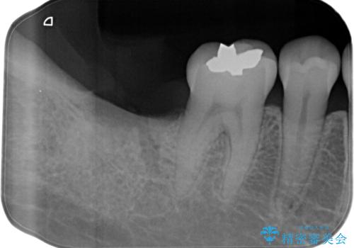 【インプラント】虫歯が大きくて歯を抜いた。の治療前