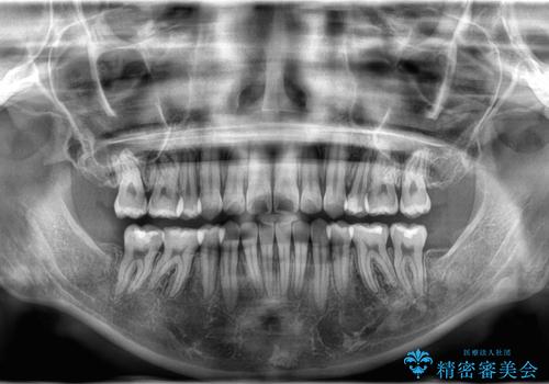 【抜歯矯正】クリア装置で1年半の治療後