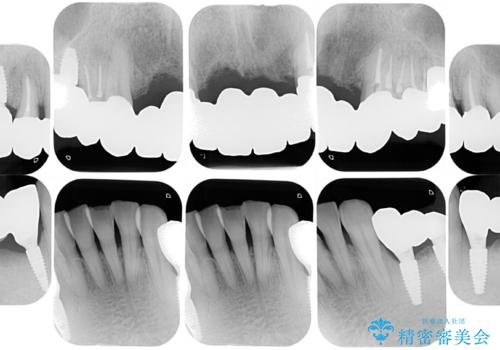 孫から口臭を指摘され来院、全顎治療で噛み合わせ、見た目、口臭全て劇的改善!の治療後