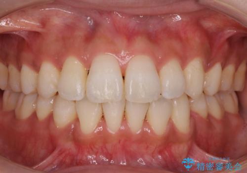 犬歯が歯ぐきにうまっている　真ん中のずれ、出っ歯を治したいの治療後