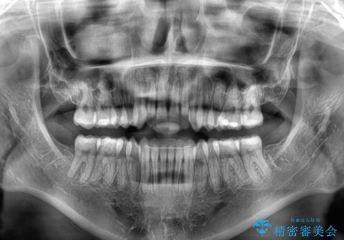【モニター】オープンバイトをインビザライン矯正で治すの治療後