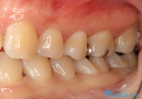 下の奥歯の銀歯を白くしたいの治療中