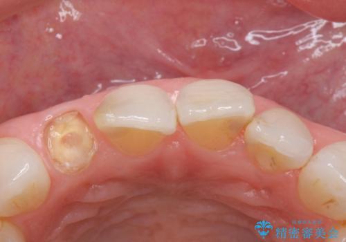 前歯が取れてしまった ジルコニアクラウンでの修復の治療前
