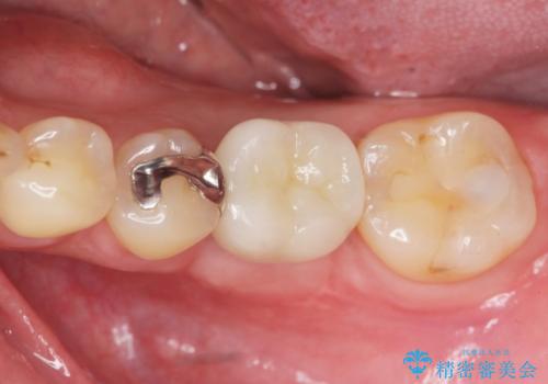 虫歯の再発による抜歯後のインプラント治療の治療後
