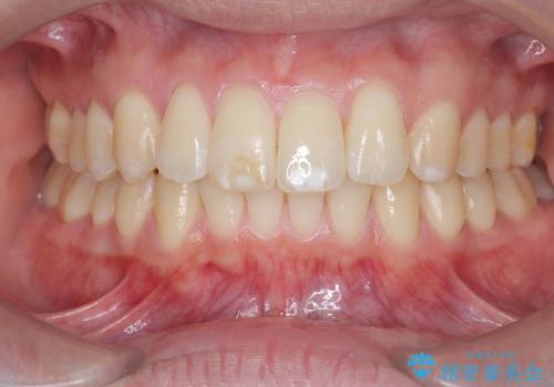 [ インビザライン ]  目立つすきっ歯をマウスピース矯正で改善の症例 治療後