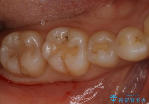 奥歯を綺麗にしたいの治療前