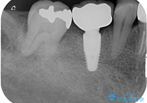 奥歯で食事をしたい　インプラントとノンクラスプデンチャーによる治療の治療後