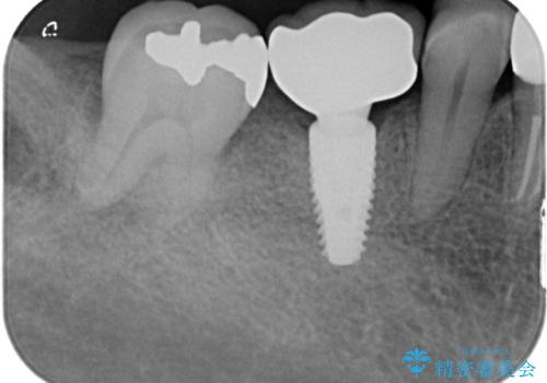 奥歯で食事をしたい インプラントとノンクラスプデンチャーによる治療の治療後
