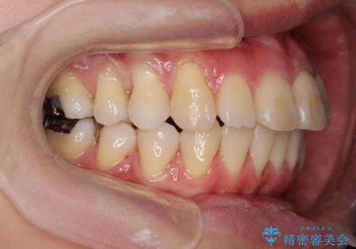捻れた奥歯 突き出た前歯を治したいの治療後
