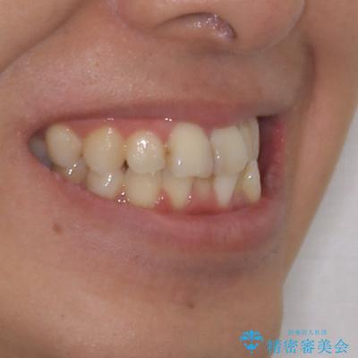 顎が左右にずれた咬み合わせ ハーフリンガルの抜歯矯正の治療前(顔貌)