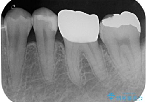 金属の詰め物が取れた オールセラミッククラウンの治療後
