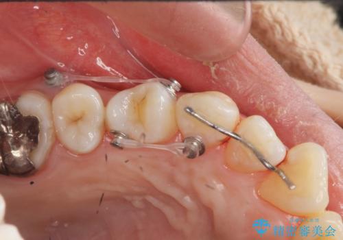 捻れた奥歯 突き出た前歯を治したいの治療前