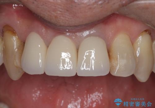 前歯を綺麗にしたいの治療後