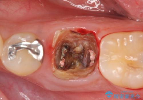 虫歯の再発による抜歯後のインプラント治療の治療前