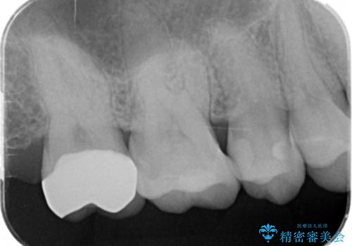 メタルフリー治療　銀歯を全て除去したいの治療後