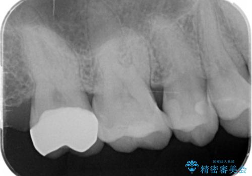 メタルフリー治療 銀歯を全て除去したいの治療後