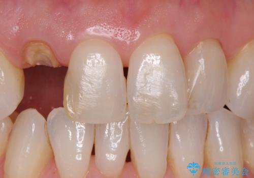 前歯が取れてしまった ジルコニアクラウンでの修復の治療前
