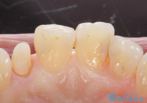 前歯が取れてしまった ジルコニアクラウンでの修復の治療中