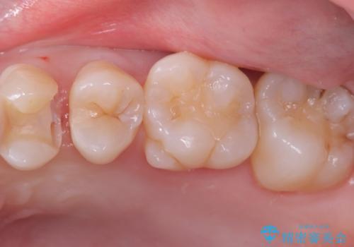 【セラミックインレー】歯が欠けたので治したいの治療中