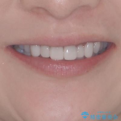 気にしていた歯並びをインビザラインで改善 セラミックも作り替えて綺麗な口元にの治療前(顔貌)