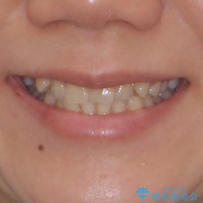 八重歯を治す 非抜歯のワイヤー矯正治療の治療前(顔貌)