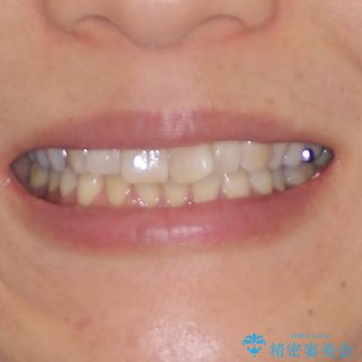 インビザラインが続けられない 忍耐のマウスピース矯正の治療前(顔貌)