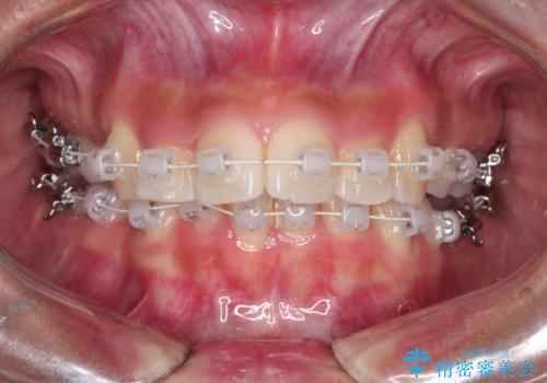 凸凹を綺麗にしたい。表側ワイヤー矯正の治療中