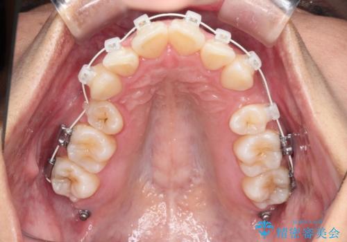 凸凹を綺麗にしたい。表側ワイヤー矯正の治療中