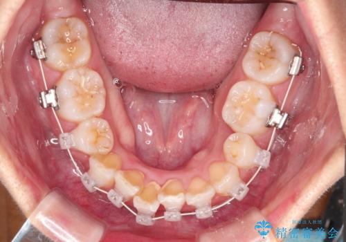 凸凹を綺麗にしたい。表側ワイヤー矯正の治療中