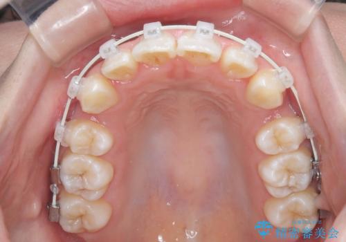 【ワイヤー矯正!】歯のでこぼこと捻じれを治したい!の治療中
