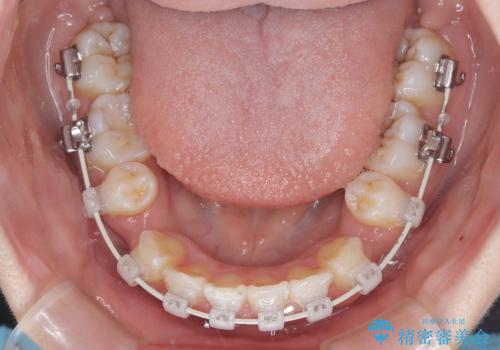 【ワイヤー矯正!】歯のでこぼこと捻じれを治したい!の治療中