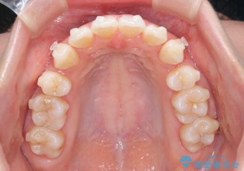 【抜歯インビザ】凸凹を綺麗になおしたいの治療中