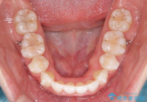 【抜歯インビザ】凸凹を綺麗になおしたいの治療中