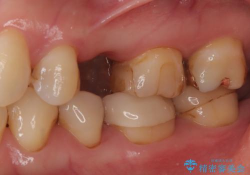 歯が割れてしまった インプラント治療で噛めるように!の治療前
