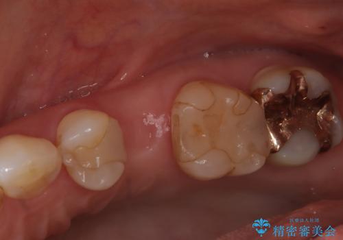 歯が割れてしまった インプラント治療で噛めるように!の治療前
