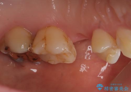歯が割れてしまった インプラント治療で噛めるように!の治療前