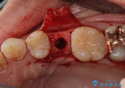 歯が割れてしまった インプラント治療で噛めるように!の治療中