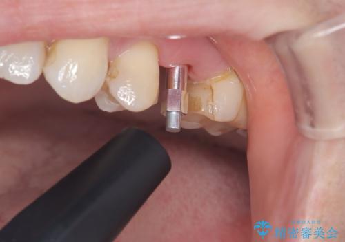 歯が割れてしまった インプラント治療で噛めるように!の治療中