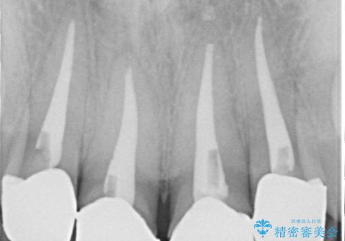 金属が見えて不自然な前歯をきれいにしたいの治療前