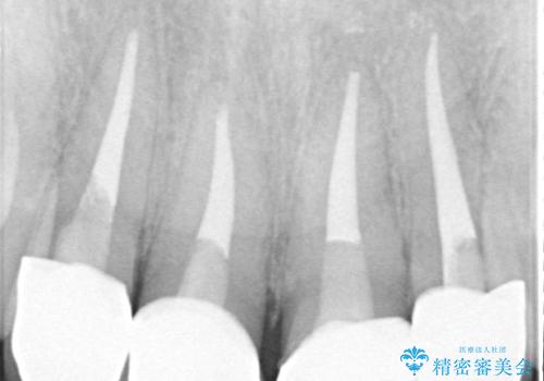 金属が見えて不自然な前歯をきれいにしたいの治療後