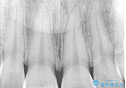 違和感のある前歯をセラミックにしたいの治療前