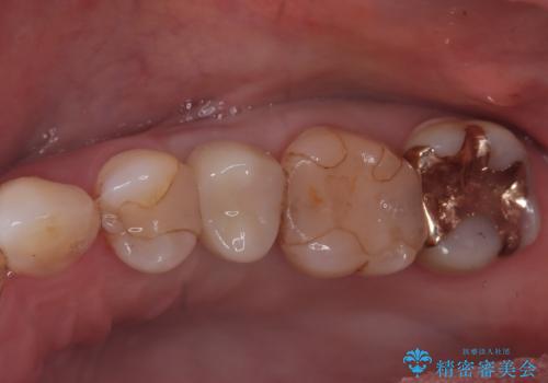 歯が割れてしまった インプラント治療で噛めるように!