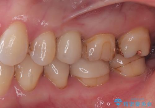 歯が割れてしまった　インプラント治療で噛めるように!の症例 治療後