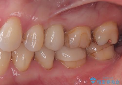 歯が割れてしまった インプラント治療で噛めるように!の治療後